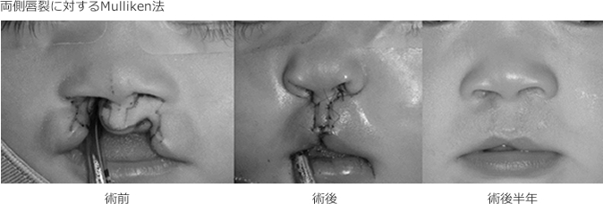両側唇裂に対するMulliken法